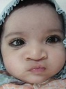 cleft-lip-and-palate