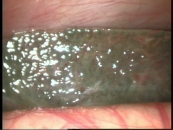 laparoscopy-in-jaundice