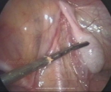 laparoscopy-in-undescended-testis