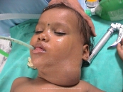 neck-cysts-and-sinus