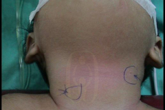 1_neck-cysts-and-sinus-1