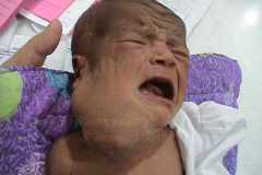 1_neck-cysts-and-sinus-2