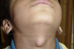 1_neck-cysts-and-sinus-4