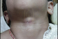 1_neck-cysts-and-sinus-5