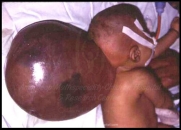 spinal-and-neural-tube-defects