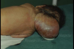 1_spinal-and-neural-tube-defects-1