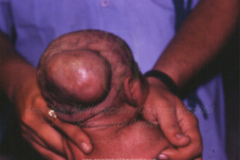 1_spinal-and-neural-tube-defects-10