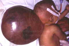 1_spinal-and-neural-tube-defects-13