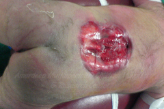 1_spinal-and-neural-tube-defects-14