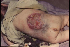 1_spinal-and-neural-tube-defects-15