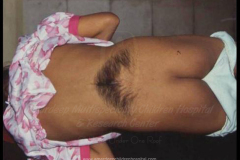 1_spinal-and-neural-tube-defects-16