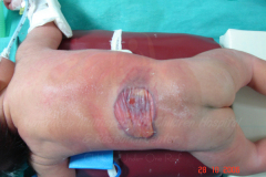 1_spinal-and-neural-tube-defects-17