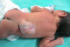 1_spinal-and-neural-tube-defects-2