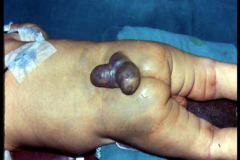 1_spinal-and-neural-tube-defects-3