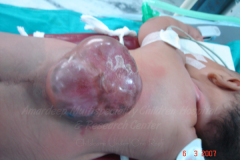 1_spinal-and-neural-tube-defects-4