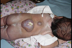 1_spinal-and-neural-tube-defects-5