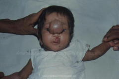 1_spinal-and-neural-tube-defects-7