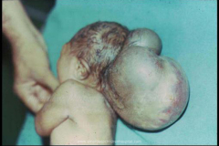1_spinal-and-neural-tube-defects-8
