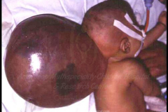 1_spinal-and-neural-tube-defects-9