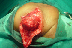 1_tumors-and-masses-10