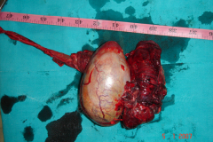 1_tumors-and-masses-14