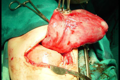 1_tumors-and-masses-8